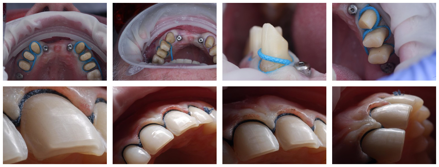 Примеры препарирования зубов под цельнокерамические реставрации во фронтальном отделе