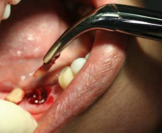 Атравматичное удаление зубов и методики наложения швов