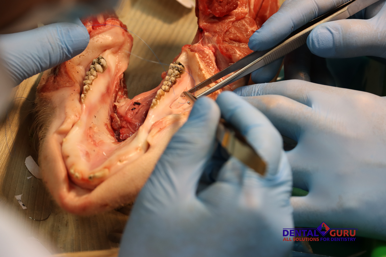 Дентальная имплантация с одновременной пластикой мягких тканей в сложных клинических случаях-photo15.bmp